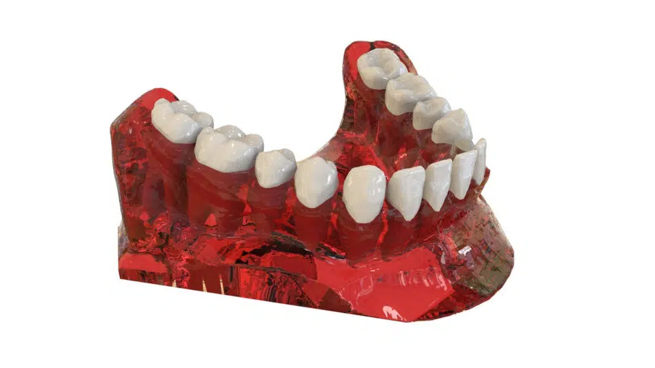 Tout savoir sur les implants dentaires